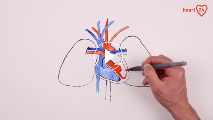 Aortenklappenstenose-defekte Herzklappe-TAVI-Erklärfilm